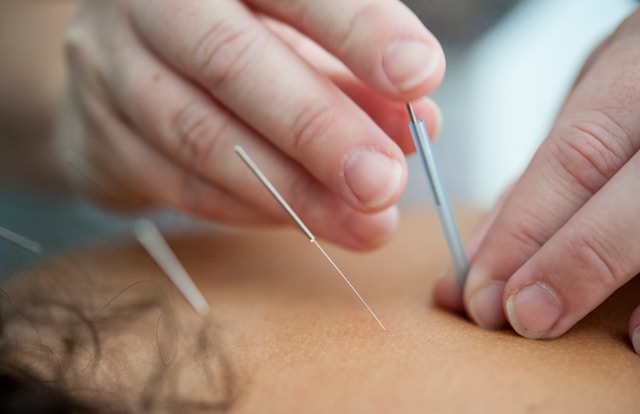 ACUPUNCTURE-physio-roses